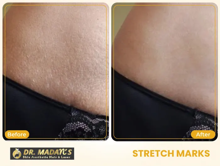 Stretch marks before and after result 6 at Dr Madan Aesthetics